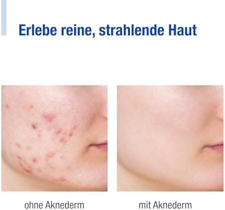 aknederm Tinktur 50ml - mit Lactic Acid/Milchsäure (AHA) und Salizylsäure (BHA) - sanfte porentiefen Hautreinigung für t