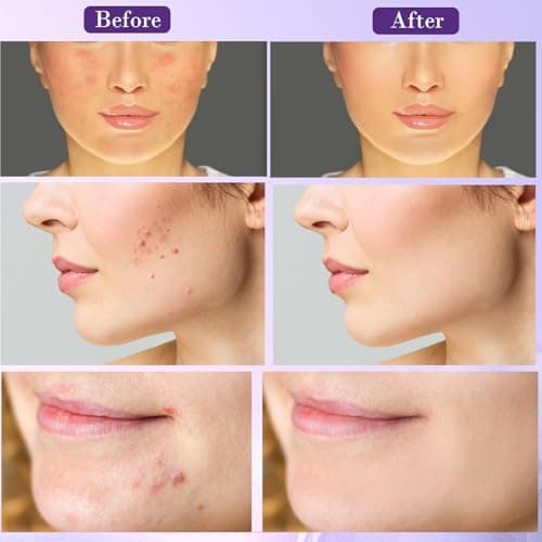 **Azelainsäure Gesichtserosionserdio Serum 12% für Frauen tegen Pickeln & Akne 20g**
| **Azelainsäure Gesichtserosionse